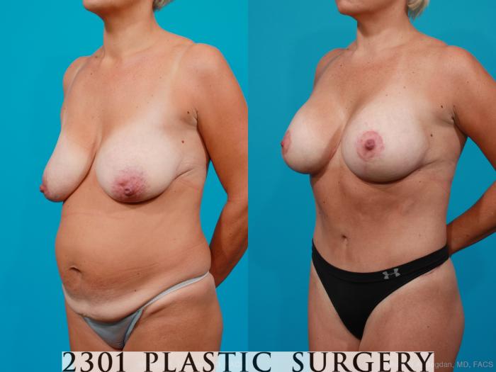 Before & After Breast Lift (Mastopexy) Case 158 View #3 View in Fort Worth, Plano, & Frisco, Texas