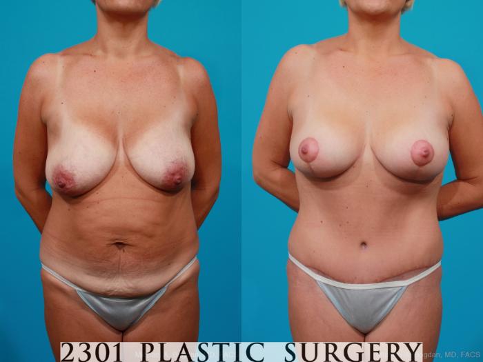 Before & After Breast Lift (Mastopexy) Case 158 View #4 View in Fort Worth, Plano, & Frisco, Texas