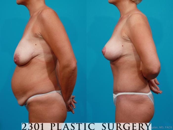 Before & After Breast Lift (Mastopexy) Case 158 View #5 View in Fort Worth, Plano, & Frisco, Texas