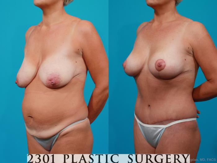 Before & After Breast Augmentation Case 158 View #6 View in Fort Worth, Plano, & Frisco, Texas