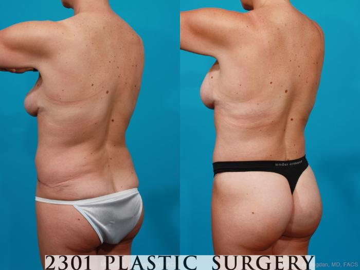 Before & After Breast Lift (Mastopexy) Case 158 View #8 View in Fort Worth, Plano, & Frisco, Texas