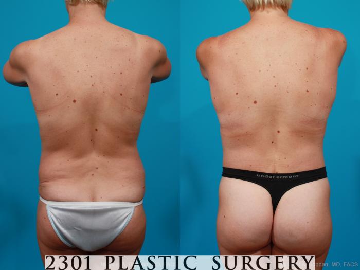 Before & After Body Lift Case 158 View #9 View in Fort Worth, Plano, & Frisco, Texas