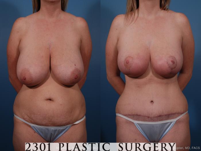 Before & After Breast Reduction Case 159 View #1 View in Fort Worth, Plano, & Frisco, Texas