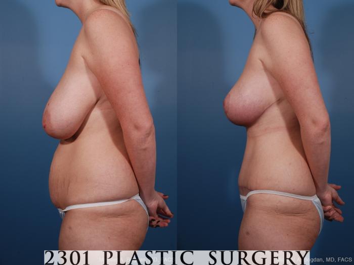 Before & After Breast Reduction Case 159 View #2 View in Fort Worth, Plano, & Frisco, Texas
