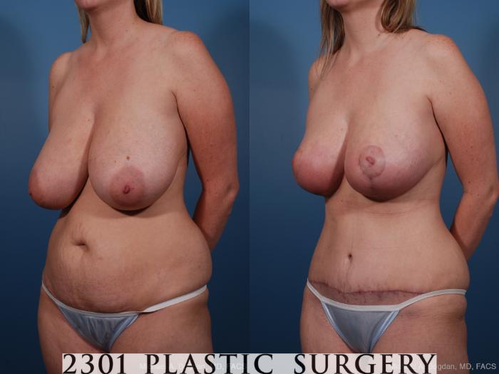 Before & After Breast Reduction Case 159 View #3 View in Fort Worth, Plano, & Frisco, Texas
