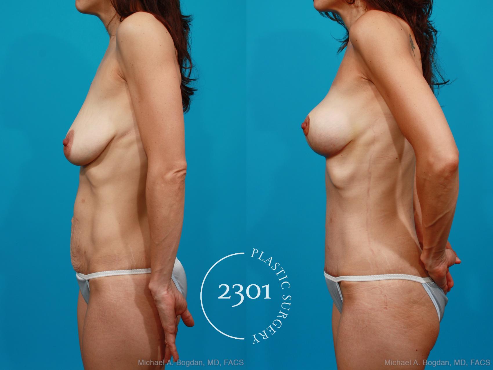 Before & After Mommy Makeover Case 171 View #2 View in Fort Worth, Plano, & Frisco, Texas