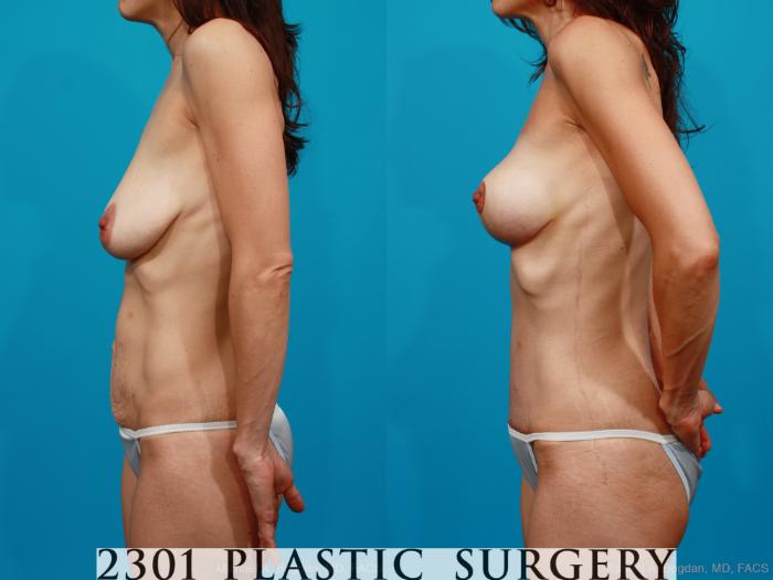 Before & After Breast Lift (Mastopexy) Case 171 View #2 View in Fort Worth, Plano, & Frisco, Texas