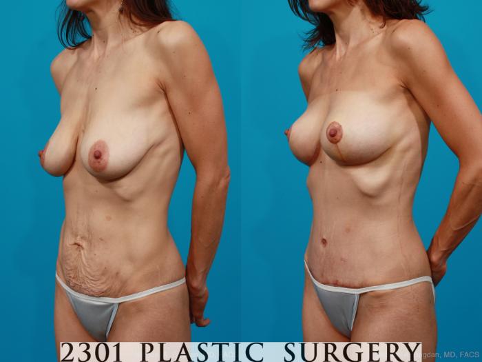 Before & After Tummy Tuck Case 171 View #3 View in Fort Worth, Plano, & Frisco, Texas