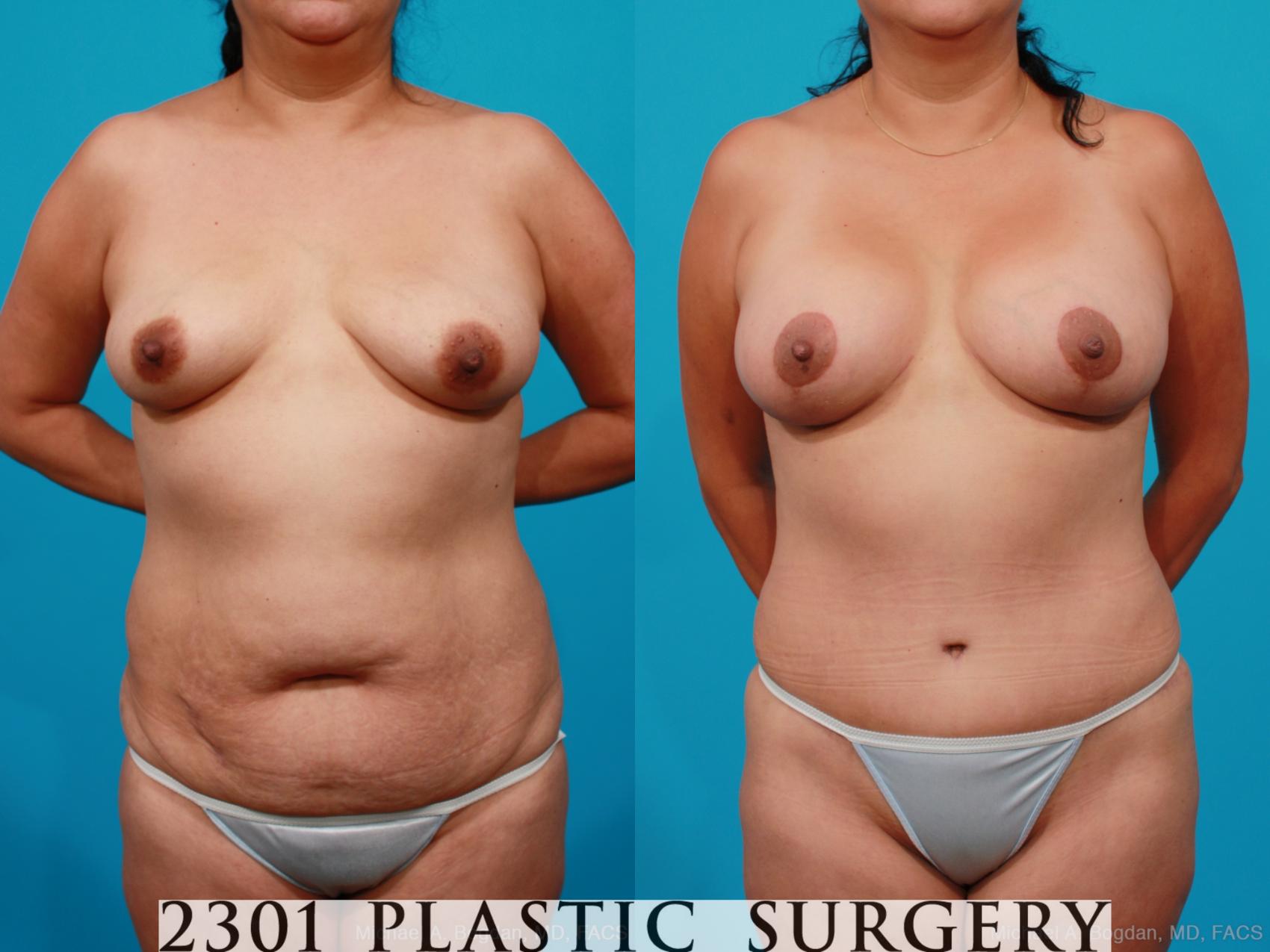 Before & After Tummy Tuck Case 173 View #1 View in Fort Worth, Plano, & Frisco, Texas