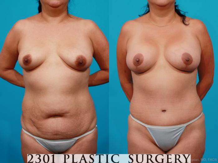 Before & After Tummy Tuck Case 173 View #1 View in Fort Worth, Plano, & Frisco, Texas