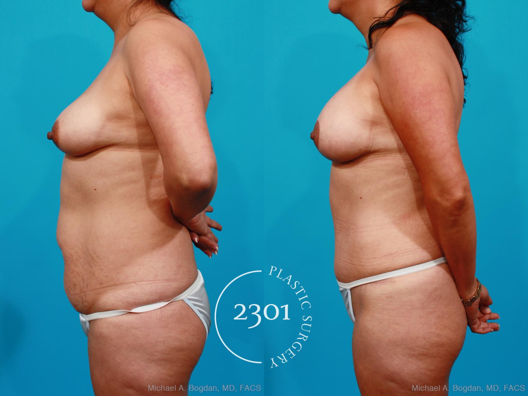 Before & After Mommy Makeover Case 173 View #2 View in Fort Worth, Plano, & Frisco, Texas