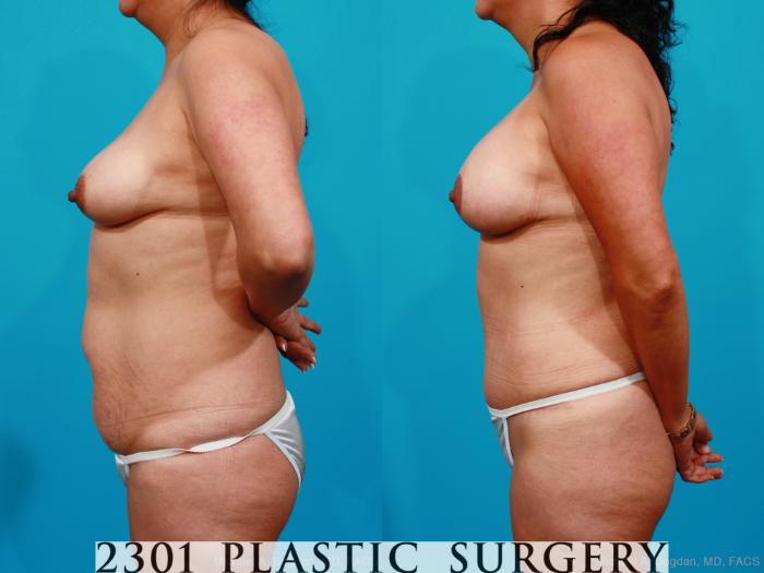 Before & After Silicone Implants Case 173 View #2 View in Fort Worth, Plano, & Frisco, Texas