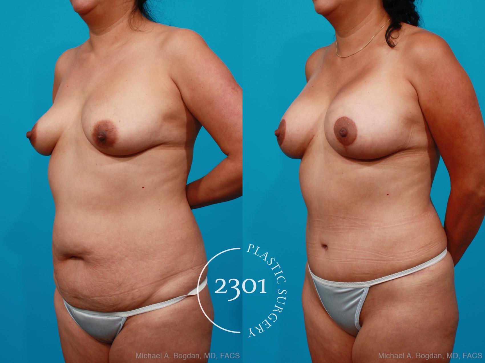 Before & After Mommy Makeover Case 173 View #3 View in Fort Worth, Plano, & Frisco, Texas