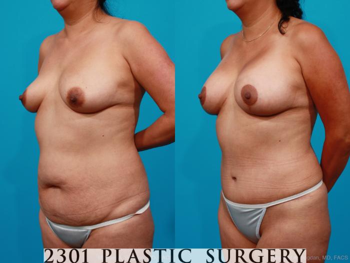 Before & After Mommy Makeover Case 173 View #3 View in Fort Worth, Plano, & Frisco, Texas