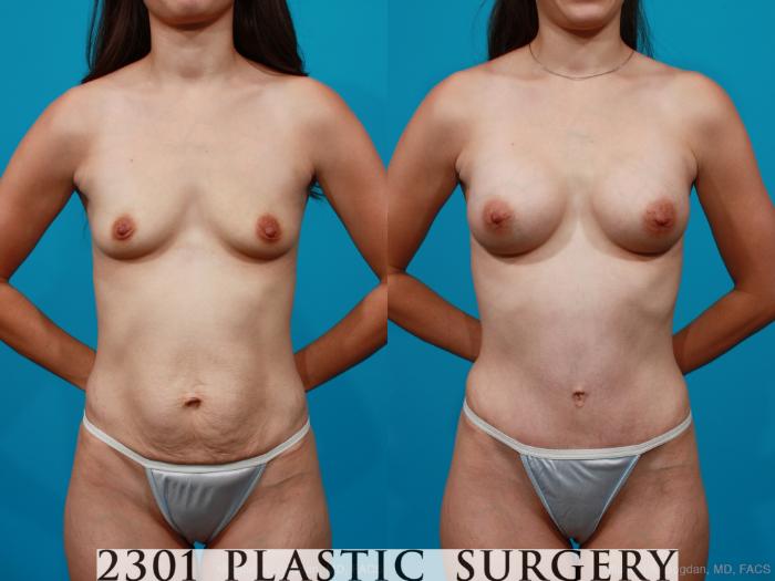 Before & After Tummy Tuck Case 175 View #1 View in Fort Worth & Frisco, Texas