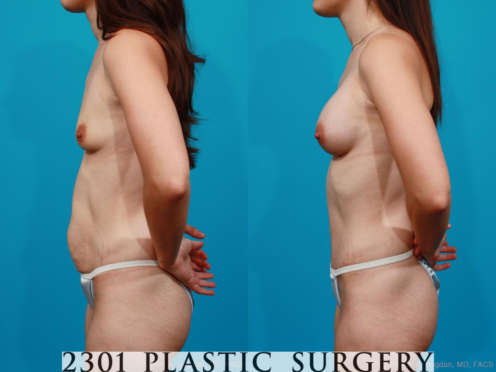Before & After Tummy Tuck Case 175 View #2 View in Fort Worth & Frisco, Texas