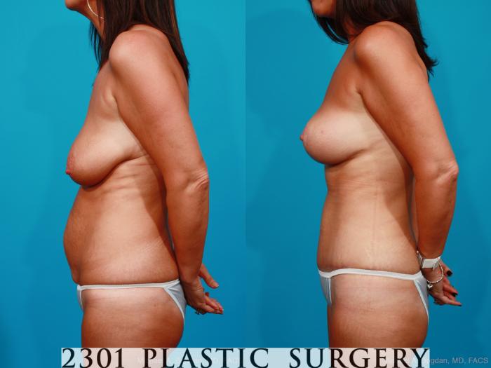 Before & After Tummy Tuck Case 183 View #2 View in Fort Worth, Plano, & Frisco, Texas