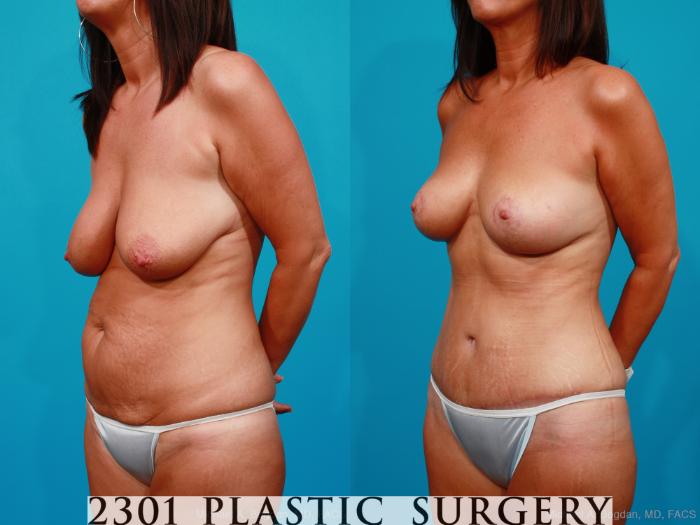 Before & After Breast Lift (Mastopexy) Case 183 View #3 View in Fort Worth, Plano, & Frisco, Texas