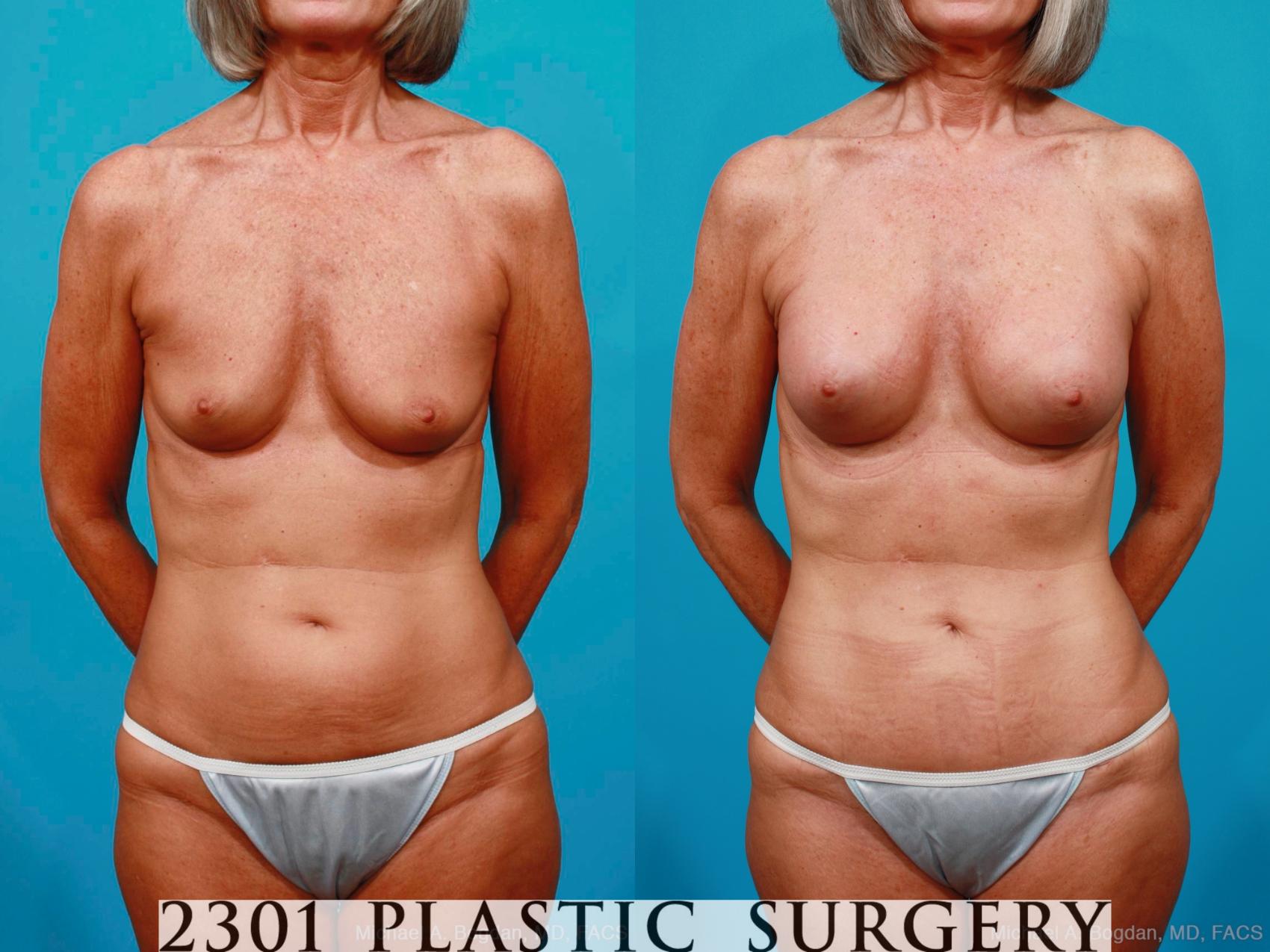 Before & After Silicone Implants Case 186 View #1 View in Fort Worth, Plano, & Frisco, Texas