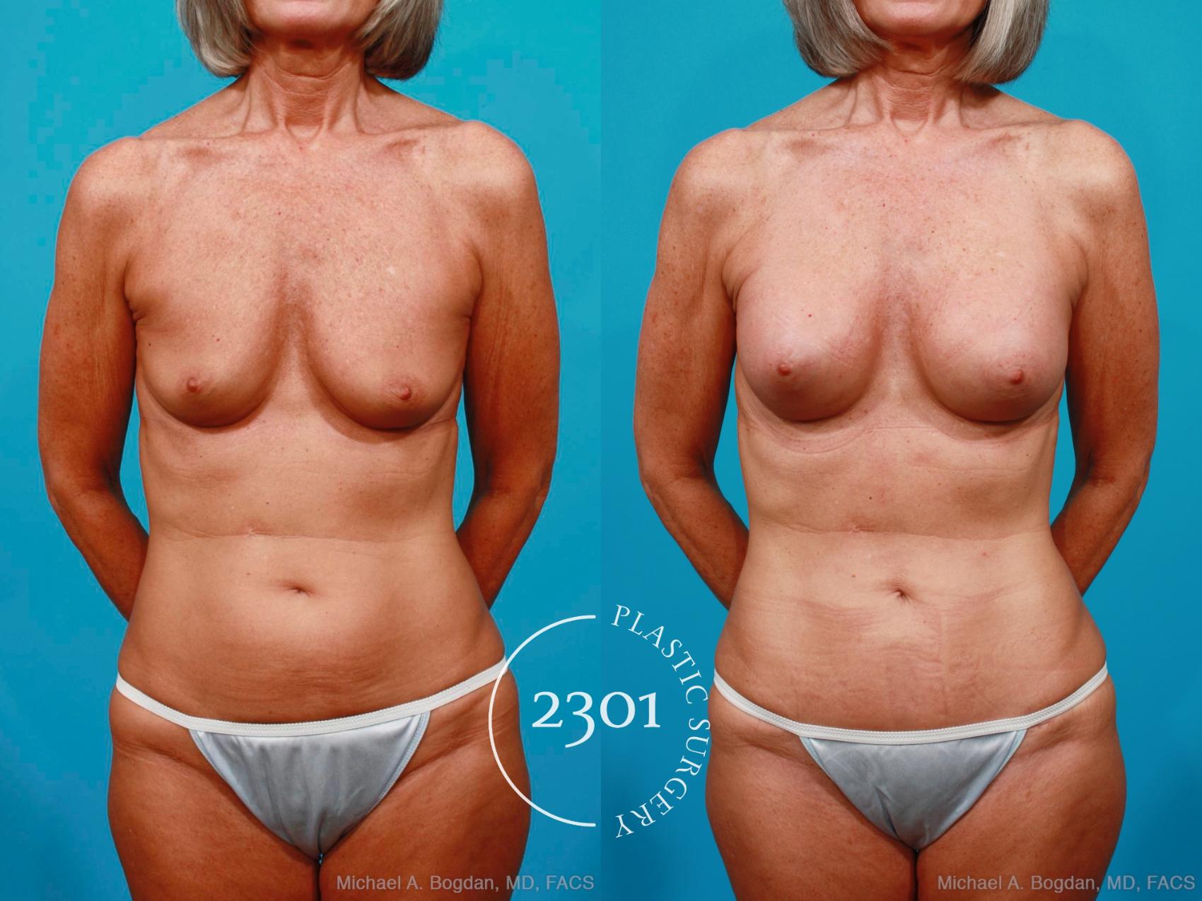 Before & After Silicone Implants Case 186 View #1 View in Fort Worth, Plano, & Frisco, Texas