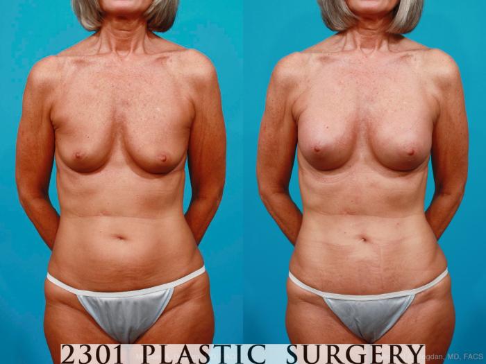 Before & After Tummy Tuck - Mini Case 186 View #1 View in Fort Worth & Frisco, Texas