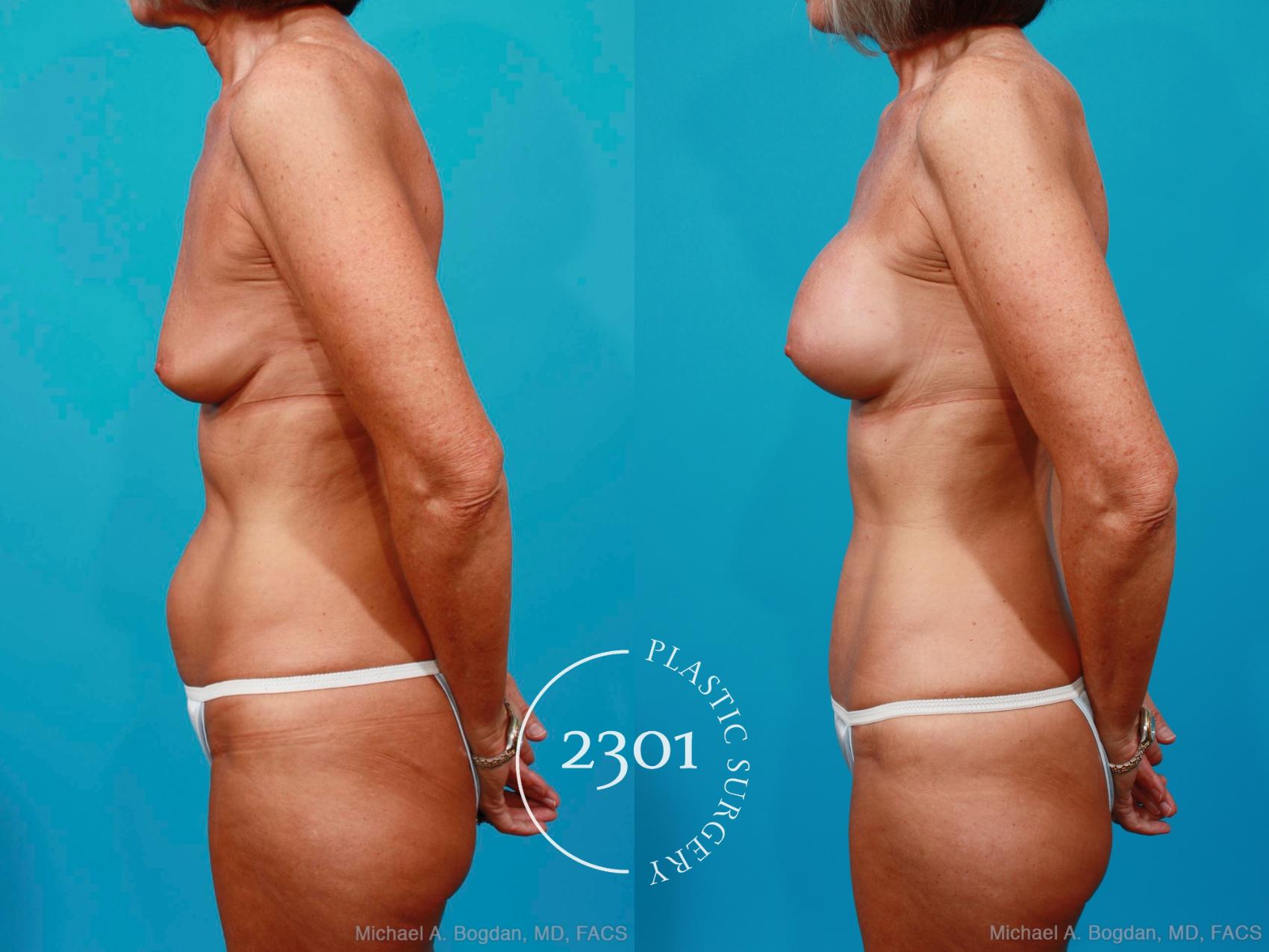 Before & After Breast Augmentation Case 186 View #2 View in Fort Worth, Plano, & Frisco, Texas