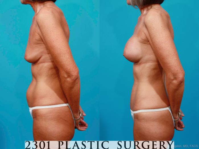 Before & After Silicone Implants Case 186 View #2 View in Fort Worth, Plano, & Frisco, Texas