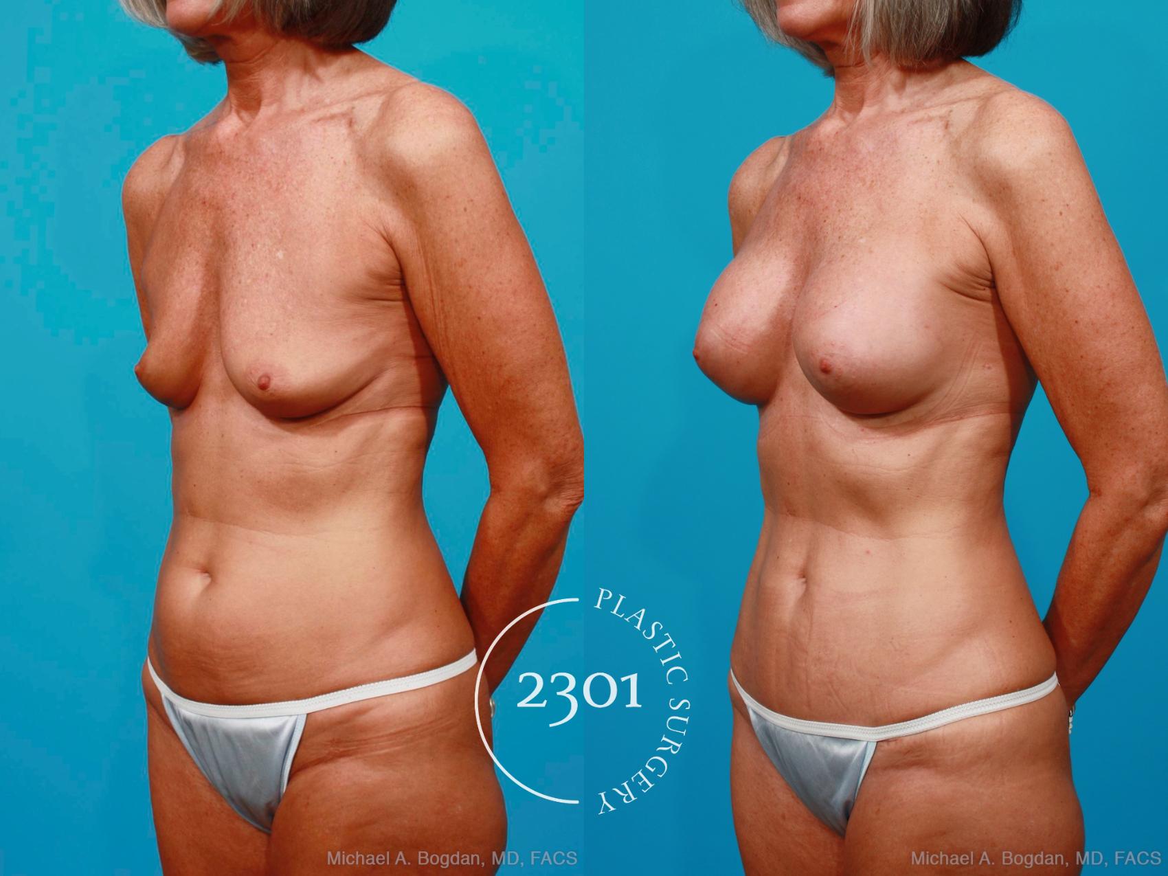 Before & After Breast Augmentation Case 186 View #3 View in Fort Worth, Plano, & Frisco, Texas