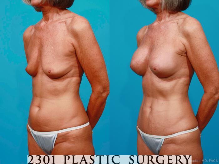 Before & After Silicone Implants Case 186 View #3 View in Fort Worth, Plano, & Frisco, Texas