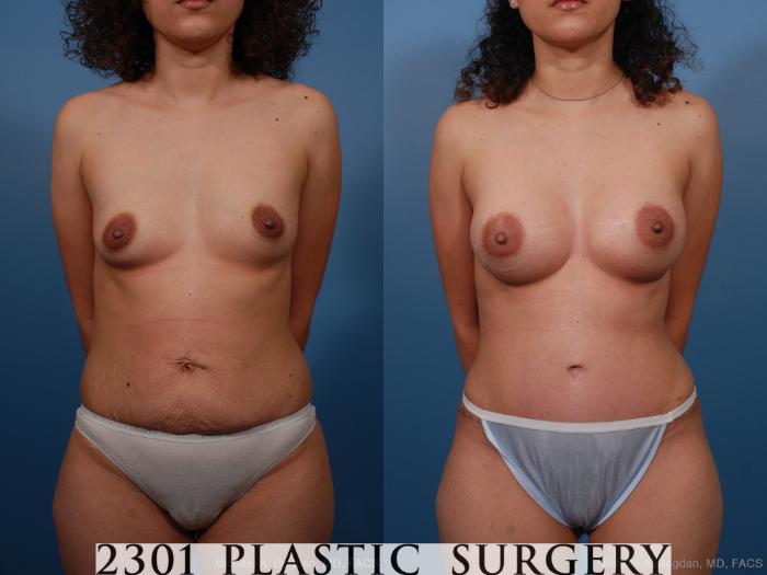 Before & After Silicone Implants Case 187 View #1 View in Fort Worth, Plano, & Frisco, Texas
