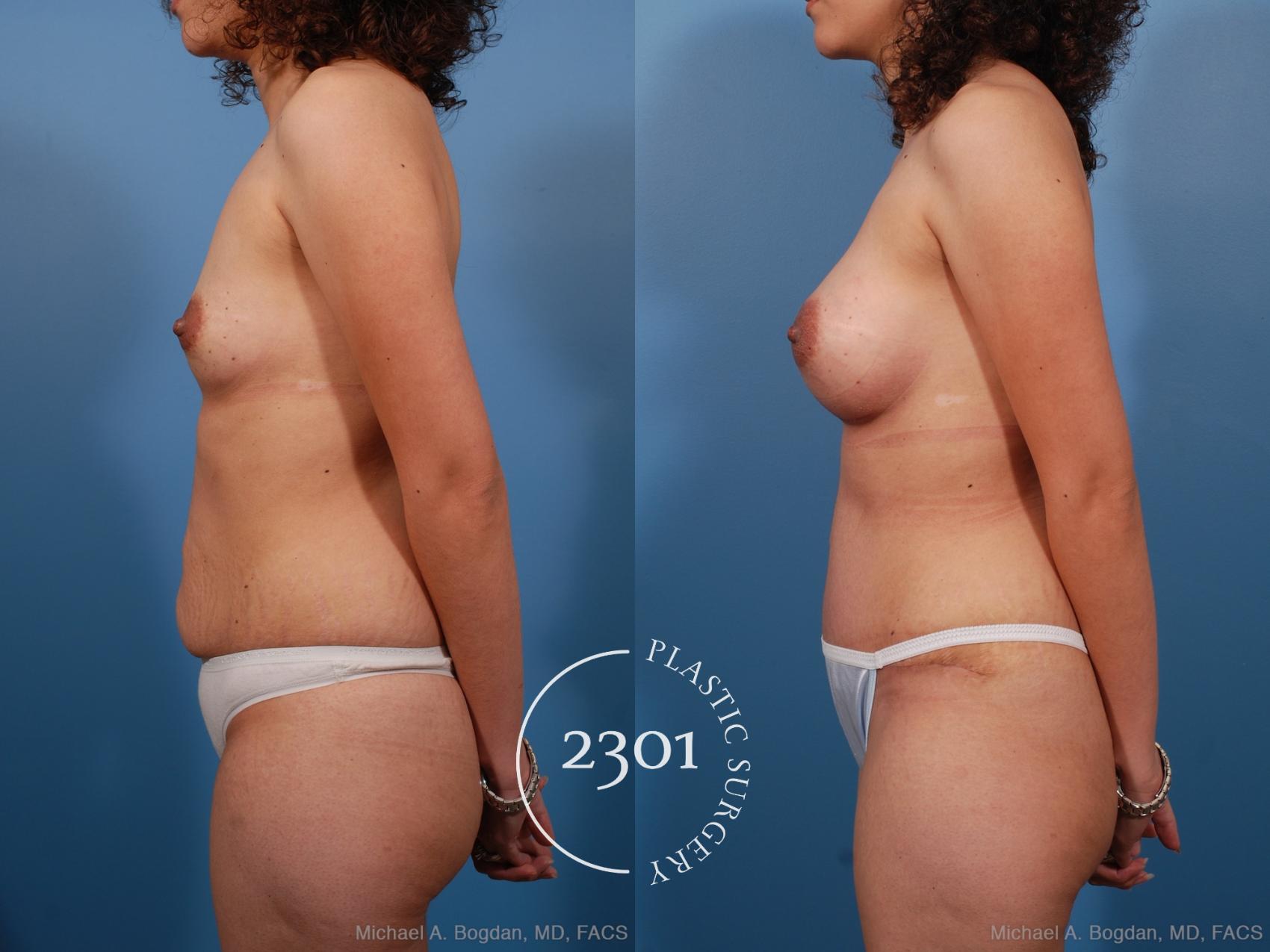 Before & After Silicone Implants Case 187 View #2 View in Fort Worth, Plano, & Frisco, Texas