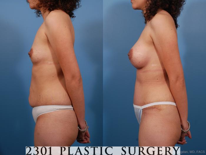 Before & After Silicone Implants Case 187 View #2 View in Fort Worth, Plano, & Frisco, Texas