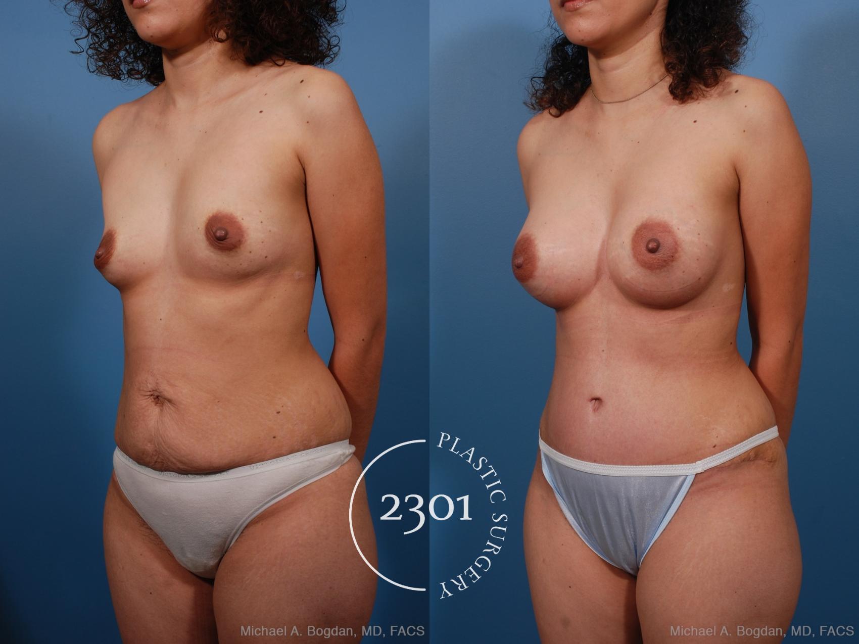 Before & After Silicone Implants Case 187 View #3 View in Fort Worth, Plano, & Frisco, Texas