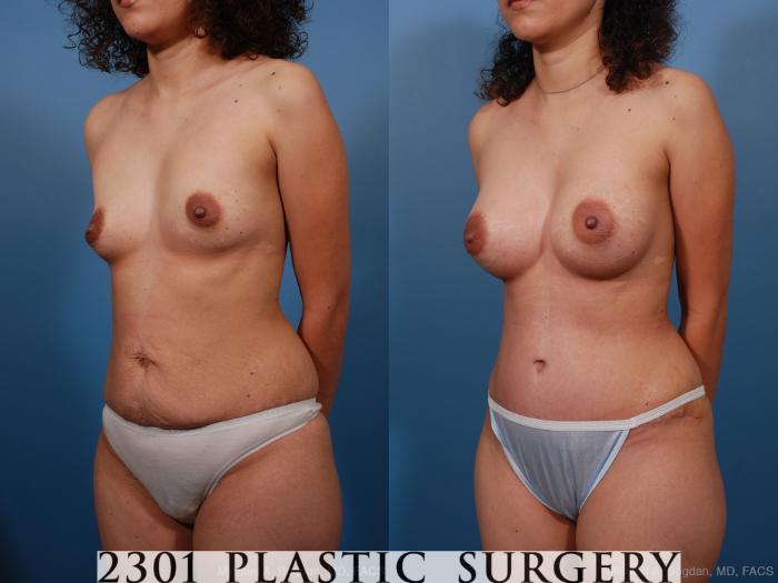 Before & After Breast Augmentation Case 187 View #3 View in Fort Worth, Plano, & Frisco, Texas
