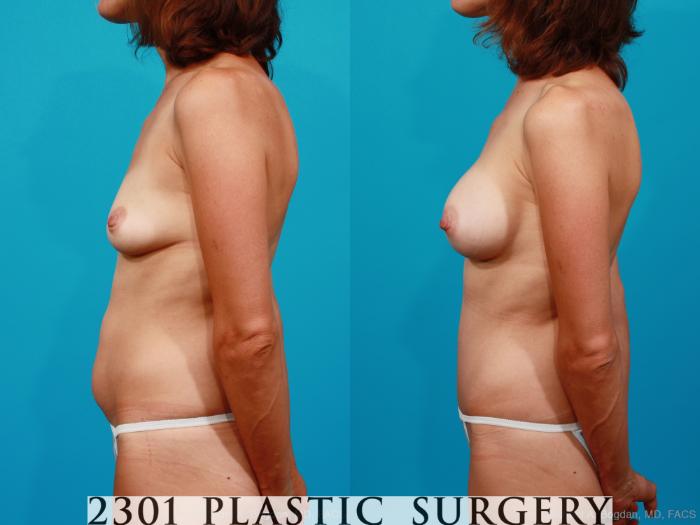 Before & After Silicone Implants Case 188 View #2 View in Fort Worth, Plano, & Frisco, Texas