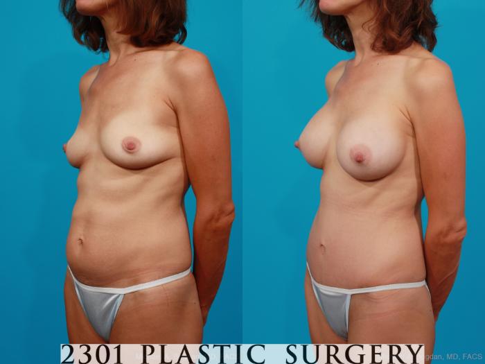 Before & After Silicone Implants Case 188 View #3 View in Fort Worth, Plano, & Frisco, Texas