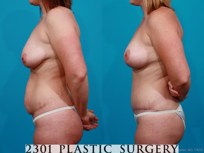 Before & After Mommy Makeover Case 190 View #2 View in Fort Worth, Plano, & Frisco, Texas