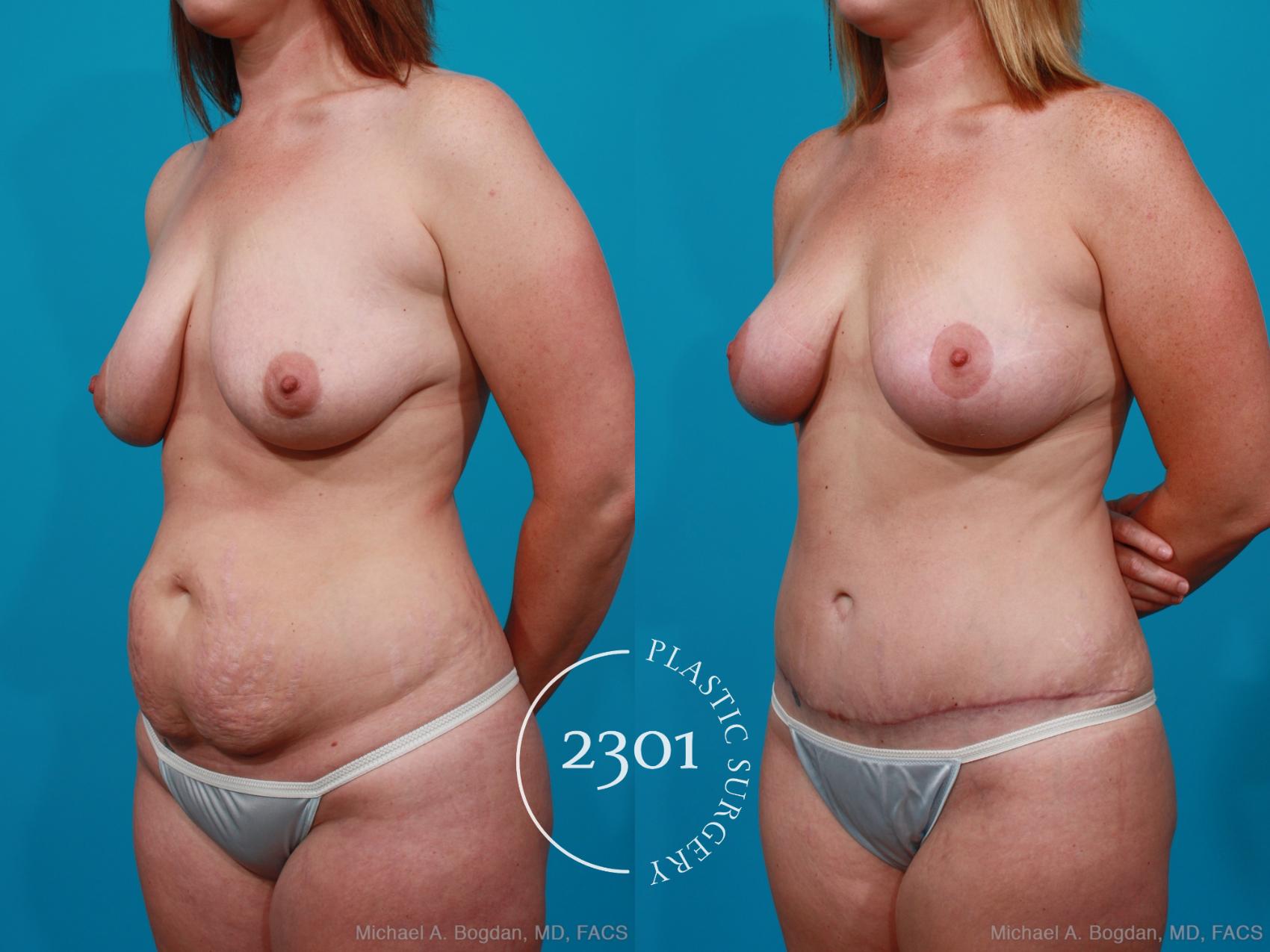 Before & After Mommy Makeover Case 190 View #3 View in Fort Worth, Plano, & Frisco, Texas