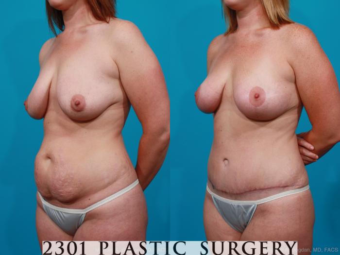 Before & After Mommy Makeover Case 190 View #3 View in Fort Worth, Plano, & Frisco, Texas