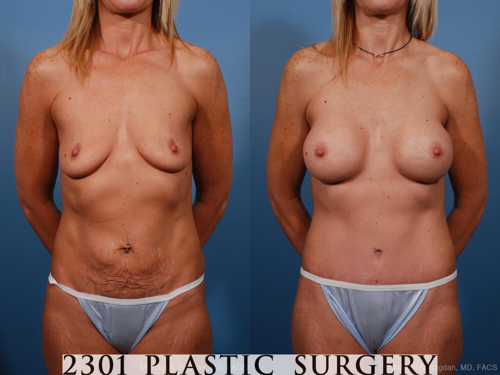 Before & After Tummy Tuck Case 191 View #2 View in Fort Worth, Plano, & Frisco, Texas