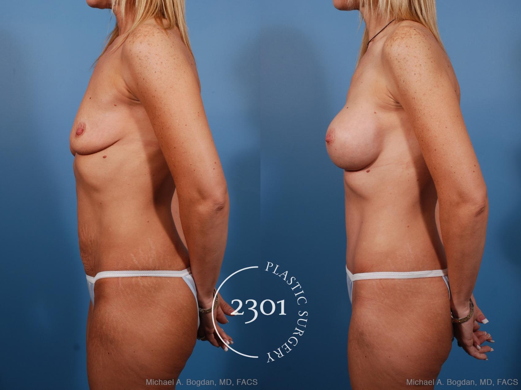 Before & After Silicone Implants Case 191 View #3 View in Fort Worth, Plano, & Frisco, Texas