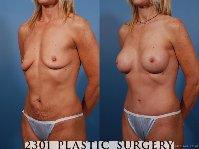Before & After Tummy Tuck Case 191 View #4 View in Fort Worth, Plano, & Frisco, Texas