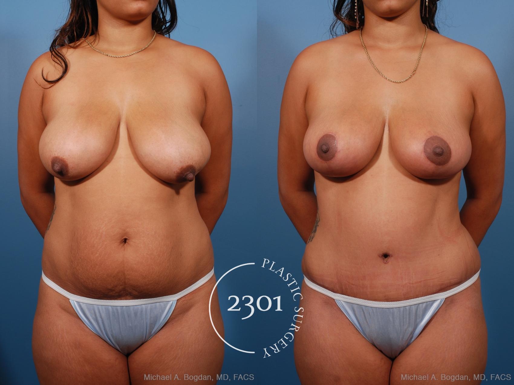 Before & After Breast Lift (Mastopexy) Case 194 View #1 View in Fort Worth, Plano, & Frisco, Texas