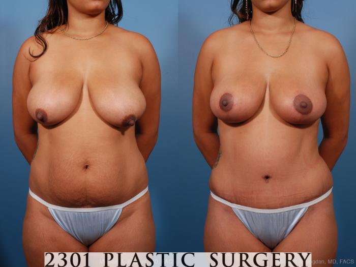 Before & After Breast Lift (Mastopexy) Case 194 View #1 View in Fort Worth, Plano, & Frisco, Texas