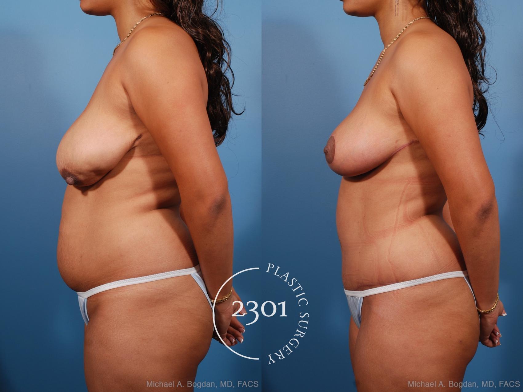 Before & After Tummy Tuck Case 194 View #2 View in Fort Worth, Plano, & Frisco, Texas