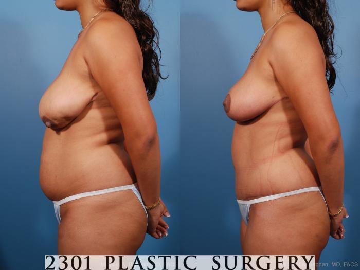 Before & After Breast Lift (Mastopexy) Case 194 View #2 View in Fort Worth, Plano, & Frisco, Texas