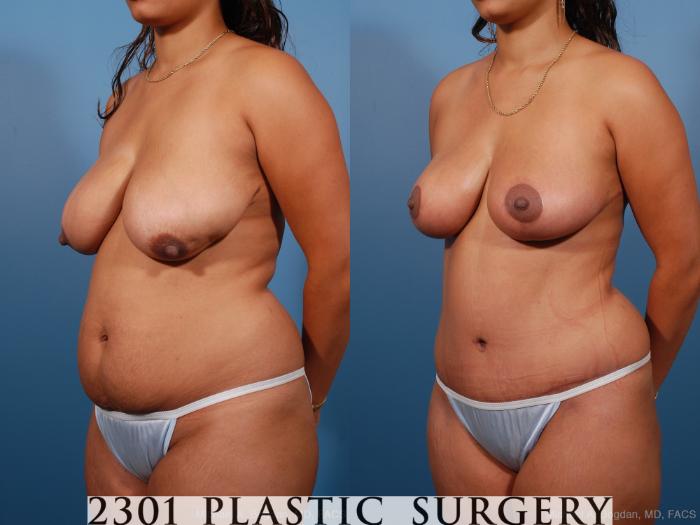 Before & After Mommy Makeover Case 194 View #3 View in Fort Worth, Plano, & Frisco, Texas