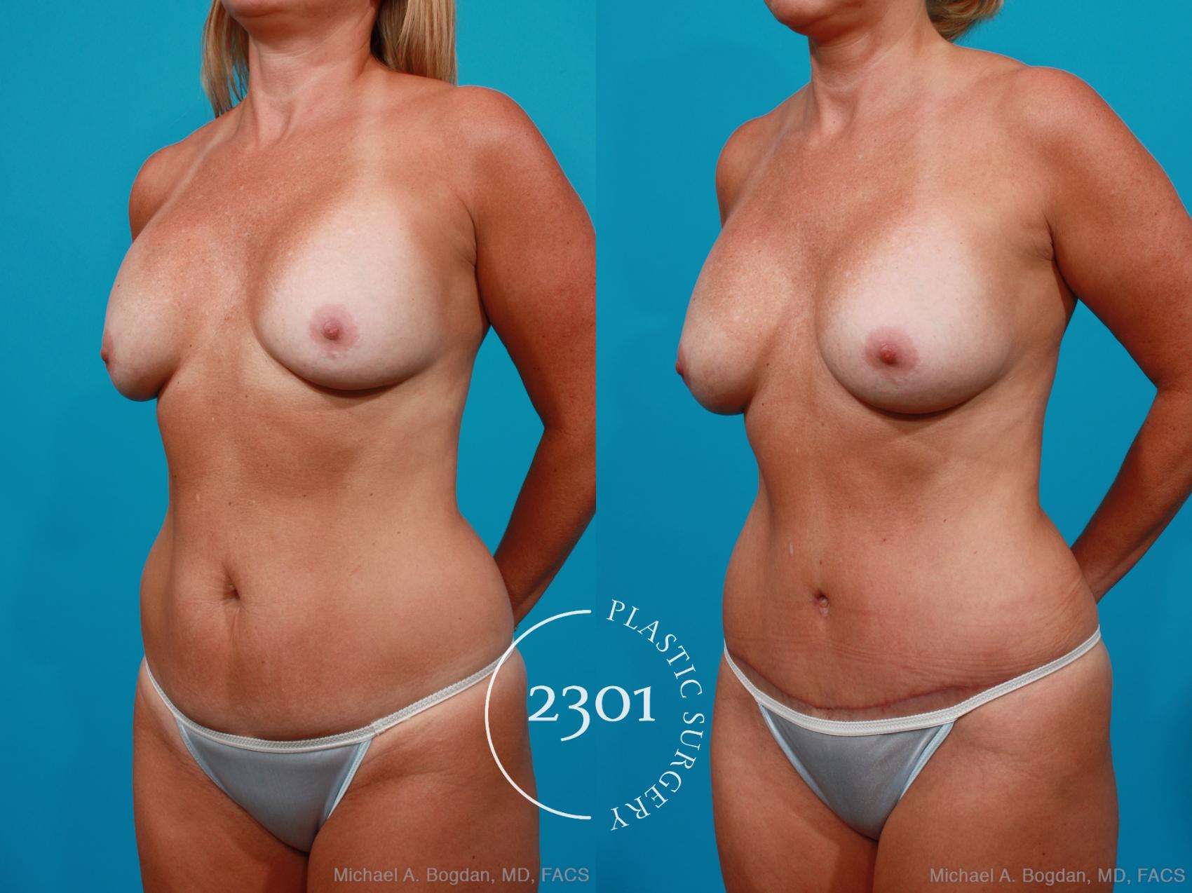 Before & After Silicone Implants Case 195 View #3 View in Fort Worth, Plano, & Frisco, Texas