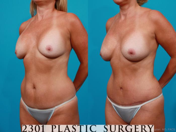 Before & After Silicone Implants Case 195 View #3 View in Fort Worth, Plano, & Frisco, Texas