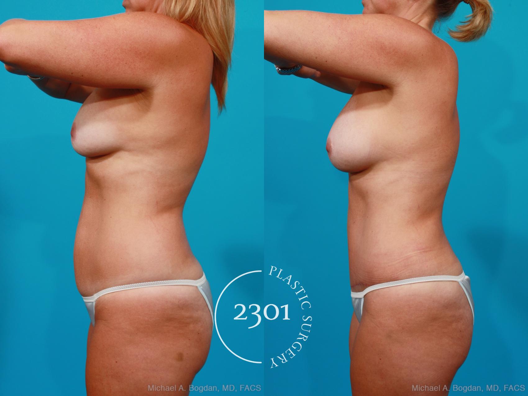 Before & After Silicone Implants Case 195 View #4 View in Fort Worth, Plano, & Frisco, Texas
